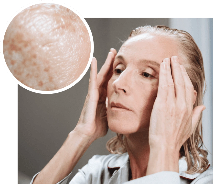 melasma.png