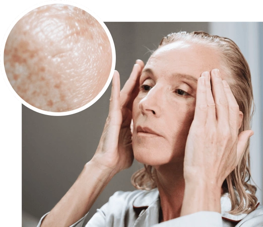 melasma.png