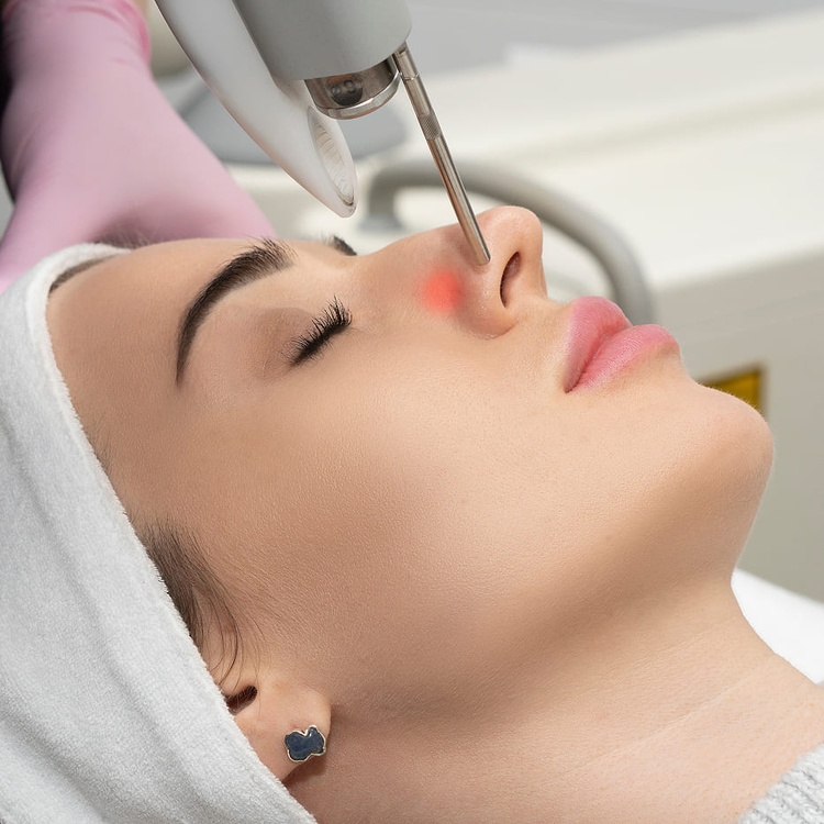 6D%20laser%20peeling.jpg